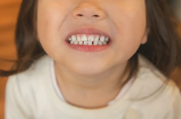 子どもに歯ぎしりが見られる時 歯ぎしり・食いしばりによる4つのリスク 部歯科 歯ぎしり・食いしばり治療 たまプラーザ 美しが丘