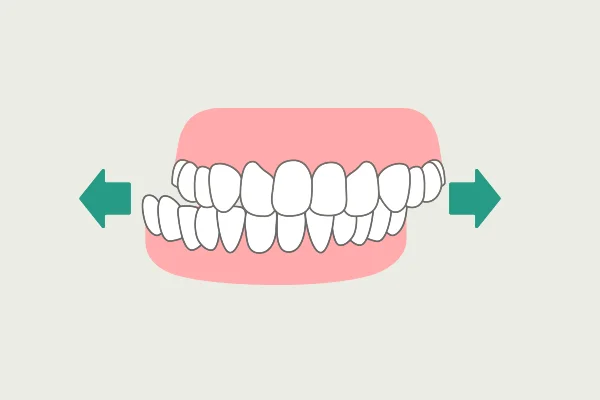 歯ぎしり・食いしばりの種類 歯ぎしり グラインディング 服部歯科 歯ぎしり・食いしばり治療 たまプラーザ 美しが丘